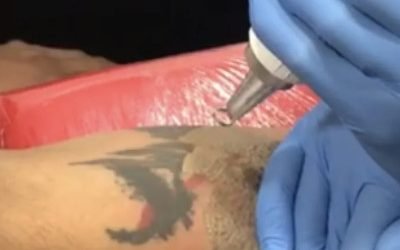 Todo sobre la eliminación de tatuajes